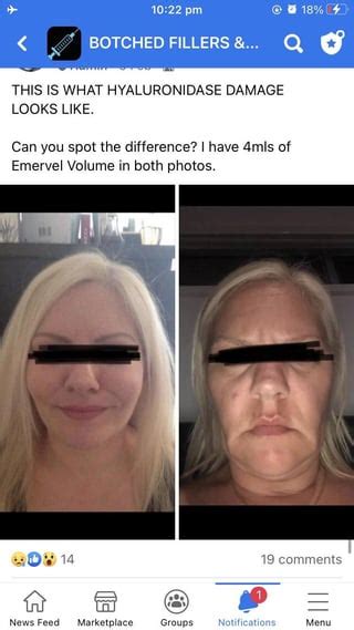 Very sad after hyaluronidase : r/30PlusSkinCare .